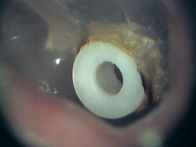 Ear (Myringotomy) Plastic Bobbin Tube
