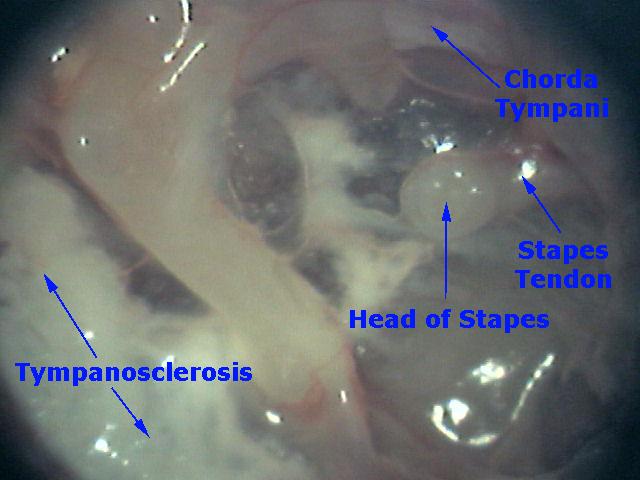 Close-Up Picture of a Retracted Eardrum - Myringostapediopexy