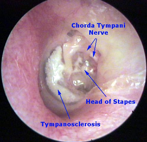 Retracted Eardrum With Tympanosclerosis and A Myringostapediopexy