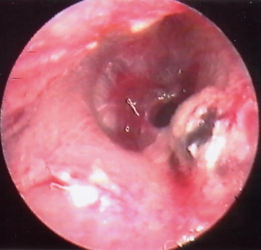 Ppsterior Superior Eardrum Hole From Acute Trauma 