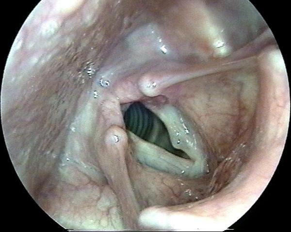Cyst of the Left True Vocal Cord - Larynx