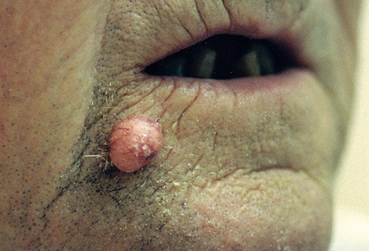 Basal Cell Carcinoma of the Lip