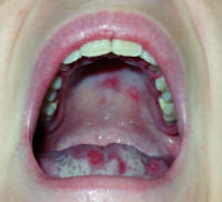 Mucositis caused by herpes simplex virus involving the tongue and palate