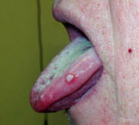 Mucositis caused by herpes simplex virus