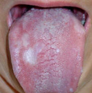 Lichen Planus of Dorsal Surface of Tongue