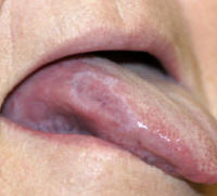 Lichenoid Reaction on the Lateral Tongue