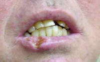 squamous cell carcinoma of the lip