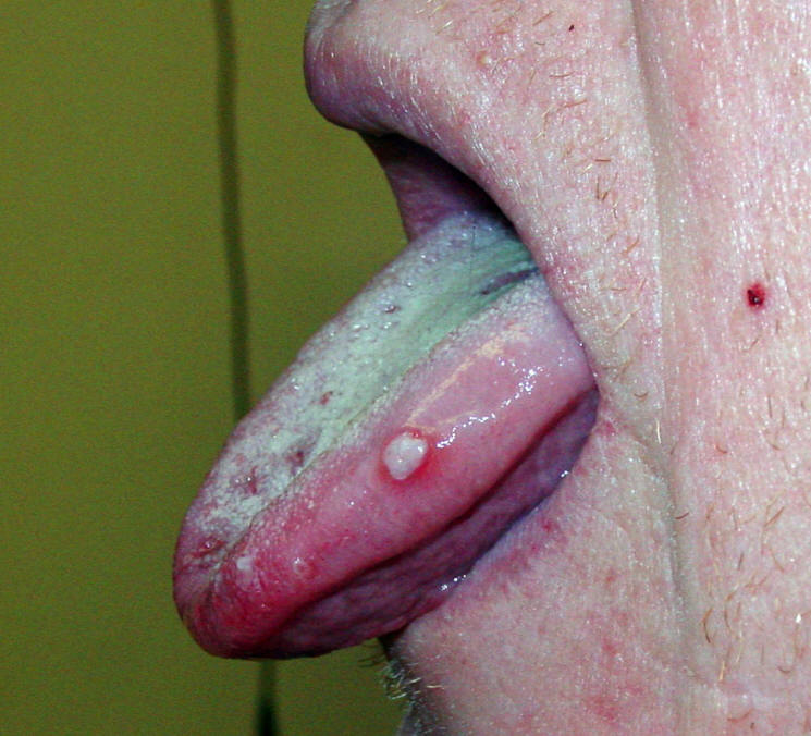Stomatitis caused by Herpes Virus With Blisters and Ulcers on the Tongue